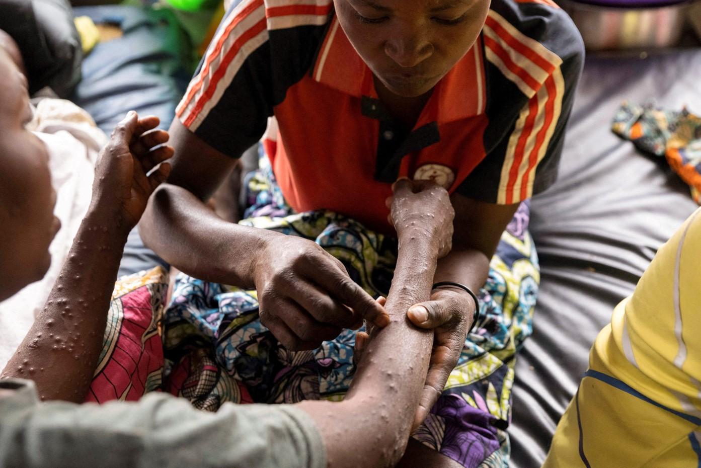 Canada Donates 200,000 Mpox Vaccine Doses to Combat Global Shortage Amid Growing Outbreaks