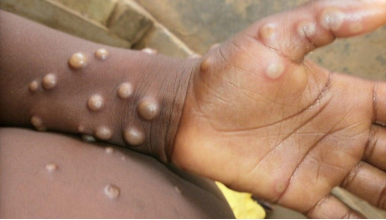 Nigeria and Eight Other Countries Receive 899,000 Mpox Vaccine Doses to Combat Outbreaks