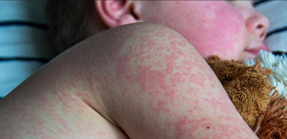 Measles Cases Surge by 20% in 2023, Highlighting Vaccine Gaps