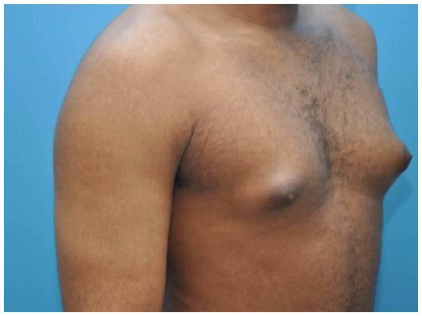 Men With Larger Breasts Face Higher Breast Cancer Risk – Expert